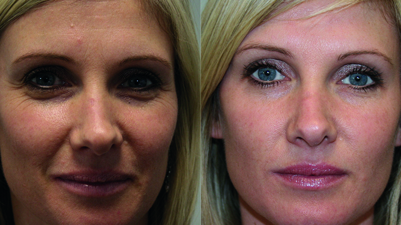 botox treatments norwich